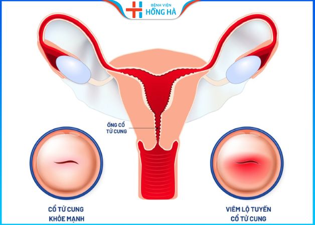 Viêm lộ tuyến cổ tử cung độ 2: Nguyên nhân và giải pháp trị an toàn hiệu quả