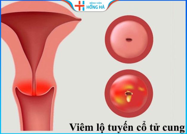 Viêm lộ tuyến độ 3 là mức độ nặng nhất của tình trạng viêm nhiễm ở cổ tử cung