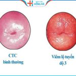 3 Phương pháp điều trị hiệu quả, an toàn viêm lộ tuyến độ 3