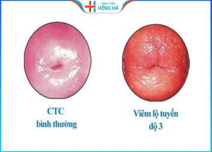 3 Phương pháp điều trị hiệu quả, an toàn viêm lộ tuyến độ 3