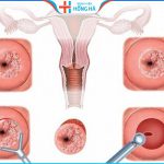 Đốt lộ tuyến: Lợi hay hại trong điều trị viêm lộ tuyến độ 3 – Lưu ý sau đốt