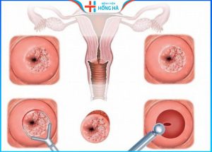 Đốt lộ tuyến: Lợi hay hại trong điều trị viêm lộ tuyến độ 3 – Lưu ý sau đốt