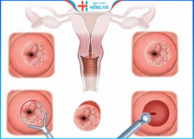 Đốt lộ tuyến: Lợi hay hại trong điều trị viêm lộ tuyến độ 3 – Lưu ý sau đốt