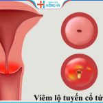 Cách phòng ngừa và điều trị viêm lộ tuyến trong thai kỳ