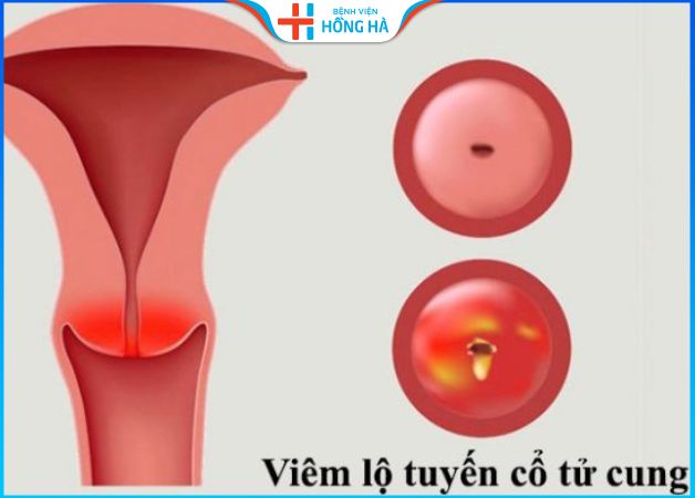 Cách phòng ngừa và điều trị viêm lộ tuyến trong thai kỳ