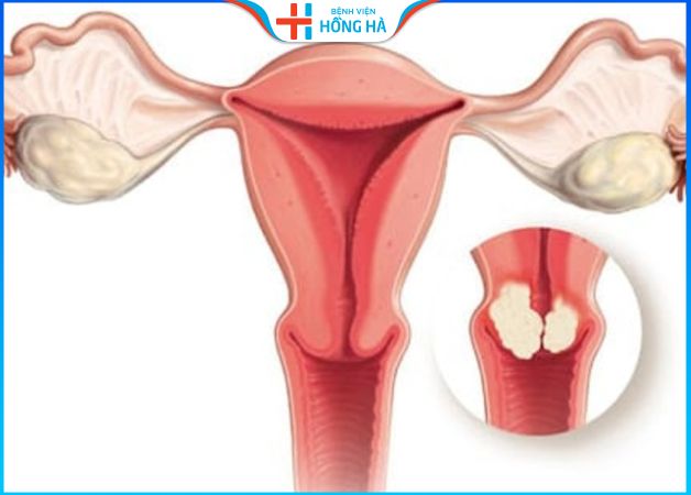Viêm lộ tuyển tử cung có nguy hiểm không – Bác sĩ giải đáp
