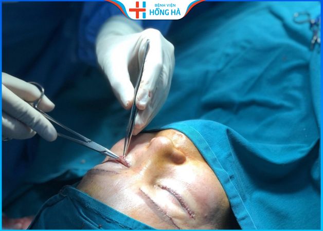 Xóa sẹo cắt mí hiệu quả và cách phòng tránh sẹo xấu