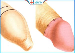 Bệnh hẹp bao quy đầu: Nguyên nhân, triệu chứng và phương pháp điều trị