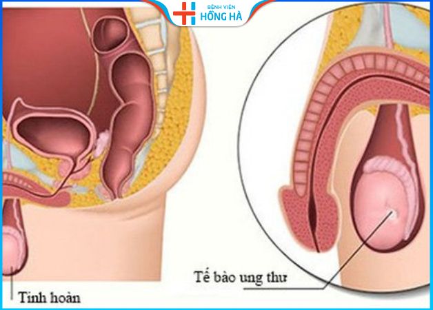 5 dấu hiệu cảnh báo cho u tinh hoàn ở nam giới