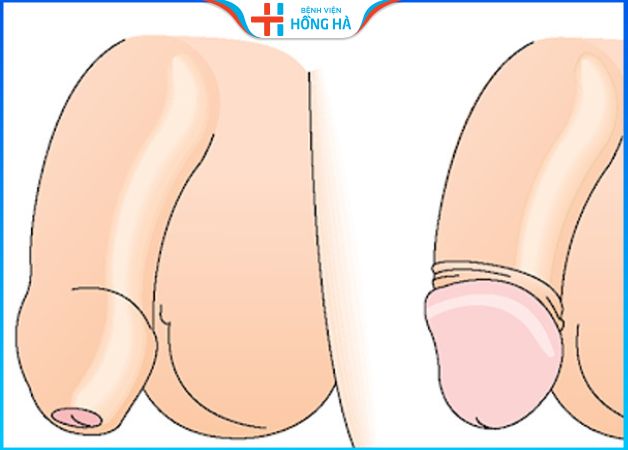 5 dấu hiệu hẹp bao quy đầu ở người lớn, tác động tới 70% nam giới