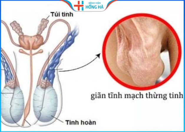 Top địa chỉ điều trị giãn tĩnh mạch thừng tinh uy tín, hiệu quả 75%