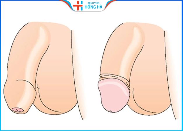 Hẹp bao quy đầu: Nên cắt hay không? Lưu ý trước khi quyết định phẫu thuật.