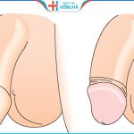 Bao quy đầu hẹp ở trẻ em: Nguyên nhân, triệu chứng & cách điều trị