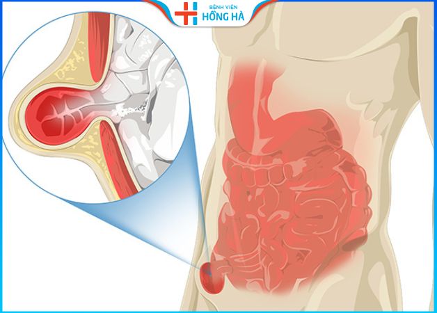 Phẫu thuật thoát vị bẹn: Giảm đau, cải thiện chất lượng cuộc sống 90%