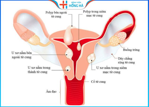 Khối u xơ xuất hiện ở tử cung