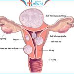 U xơ tử cung có phải là ung thư không – 3 Phương pháp trị u xơ