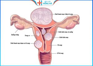 U xơ tử cung: Liệu có phải là một loại ung thư – 3 Phương pháp trị u xơ