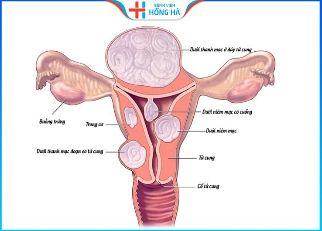 U xơ tử cung: Liệu có phải là một loại ung thư – 3 Phương pháp trị u xơ