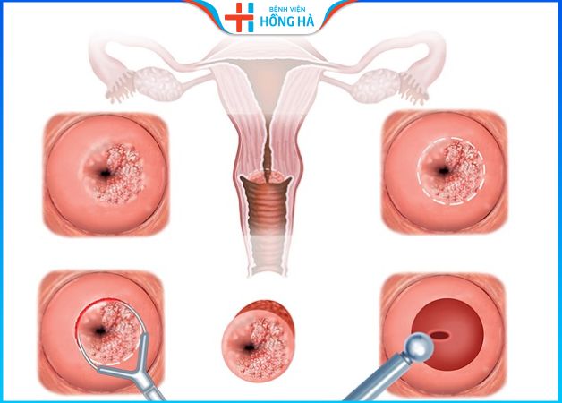 Viêm lộ tuyến tử cung là tình trạng tế bào tuyến phát triển lan ra ngoài tử cung