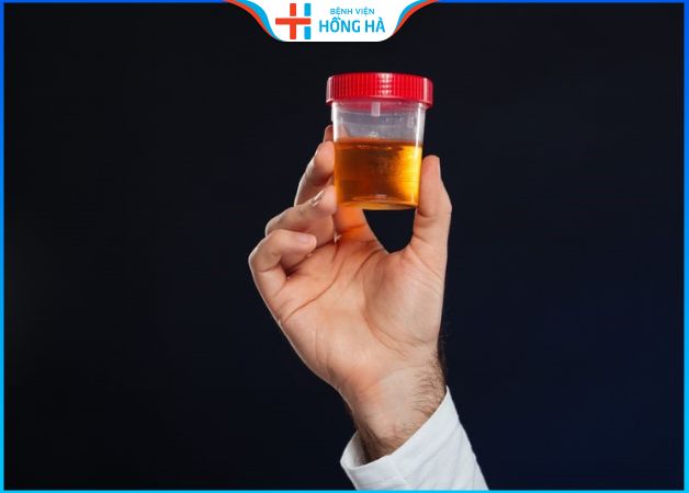 Nước tiểu màu vàng đậm: Nguyên nhân, cách điều trị