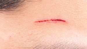 10+ cách làm vết thương hở mau khô từ nguyên liệu tự nhiên