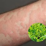 11 Cách trị nổi mẩn đỏ ngứa an toàn, hiệu quả