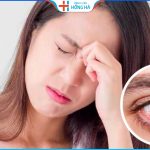 Các giai đoạn đau mắt đỏ và cách chữa nhanh khỏi nhất