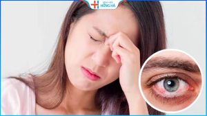 Các giai đoạn đau mắt đỏ và cách chữa nhanh khỏi nhất