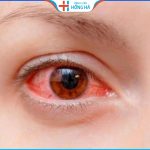 5 Cách chữa đau mắt đỏ nhanh nhất không phải ai cũng biết