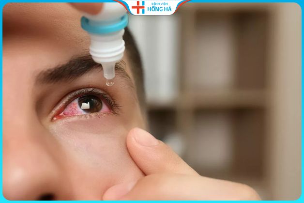 Cách chữa đau mắt đỏ nhanh nhất