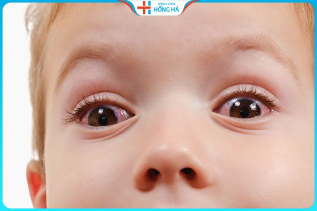 Người bị đau mắt đỏ có nên uống kháng sinh