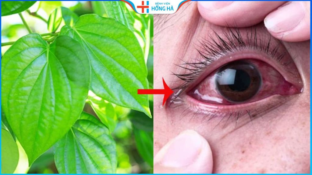 Chữa đau mắt đỏ bằng lá trầu không có an toàn và hiệu quả