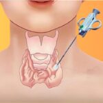 Chọc hút dịch – tiêm cồn nang tuyến giáp là gì? Quy trình và lưu ý quan trọng