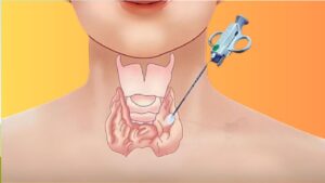 Chọc hút dịch – tiêm cồn nang tuyến giáp là gì? Quy trình và lưu ý quan trọng