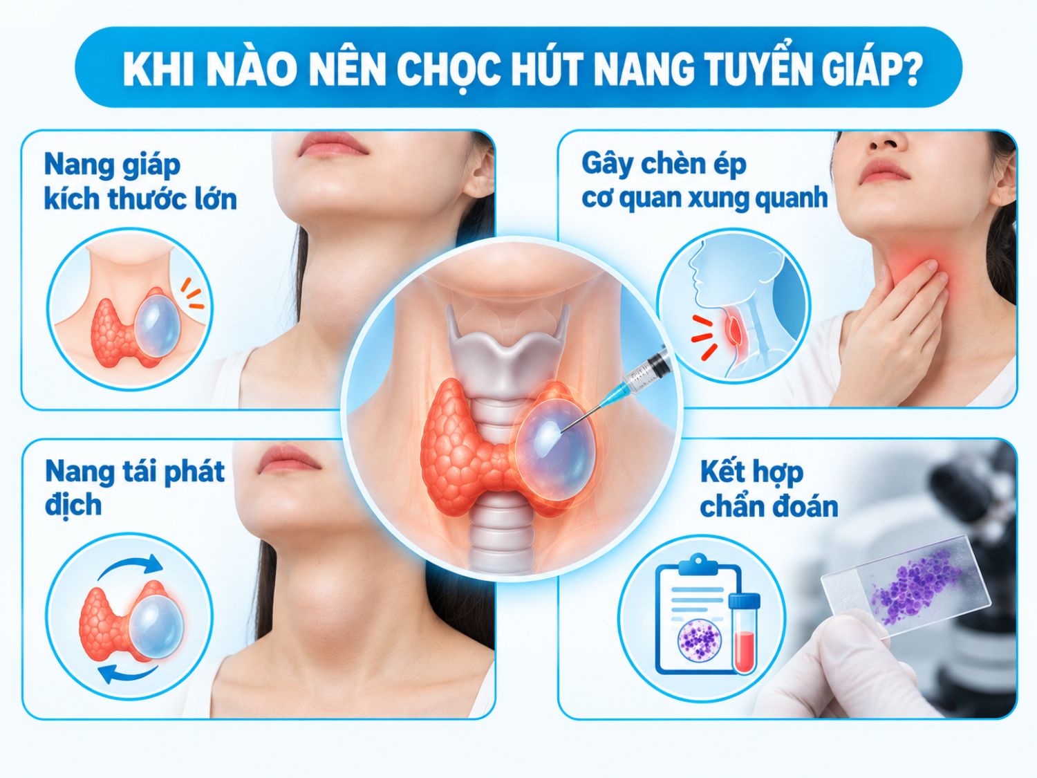 Chọc hút nang tuyến giáp thường được cân nhắc khi nang có kích thước lớn, gây chèn ép các cơ quan xung quanh