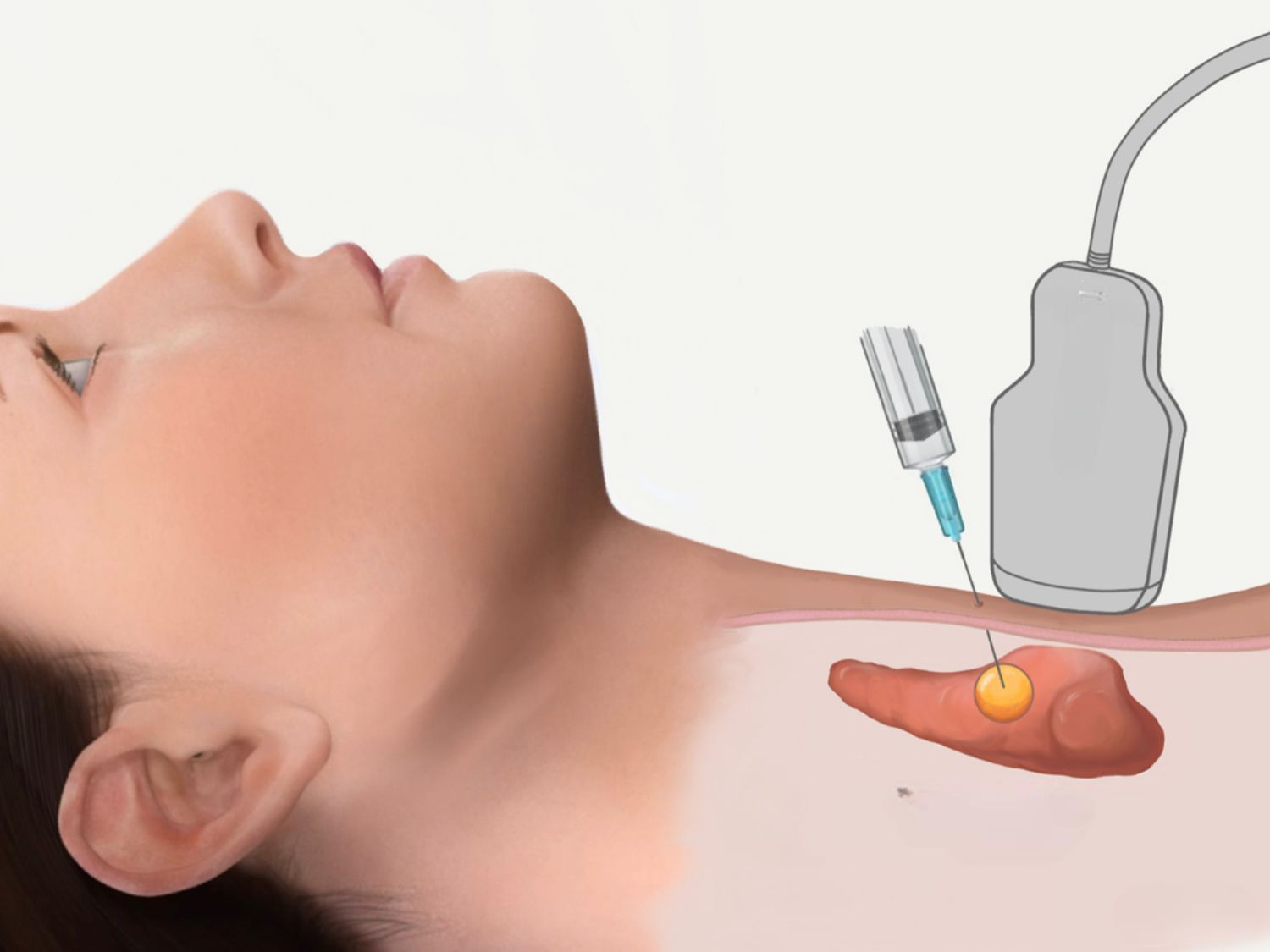 Chọc hút nang tuyến giáp là phương pháp sử dụng kim nhỏ để dẫn lưu dịch bên trong nang