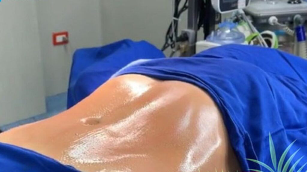 Hút mỡ Thai Hi-Lipo – Giải pháp lấy lại vòng eo con kiến nhanh chóng