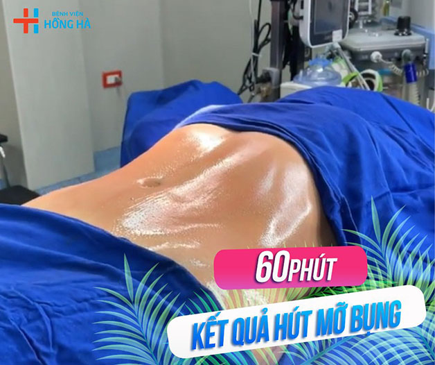 Hút mỡ tại Bệnh viện Đa khoa Hồng Hà