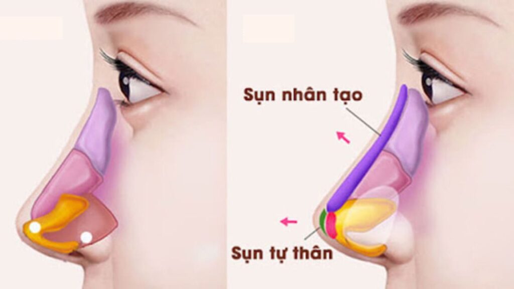 Nâng mũi cấu trúc Thai Shape tại Bệnh viện Hồng Hà: Tạo dáng mũi hài hòa, cân đối