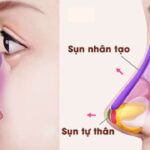 Nâng mũi cấu trúc Thai Shape tại Bệnh viện Hồng Hà: Tạo dáng mũi hài hòa, cân đối