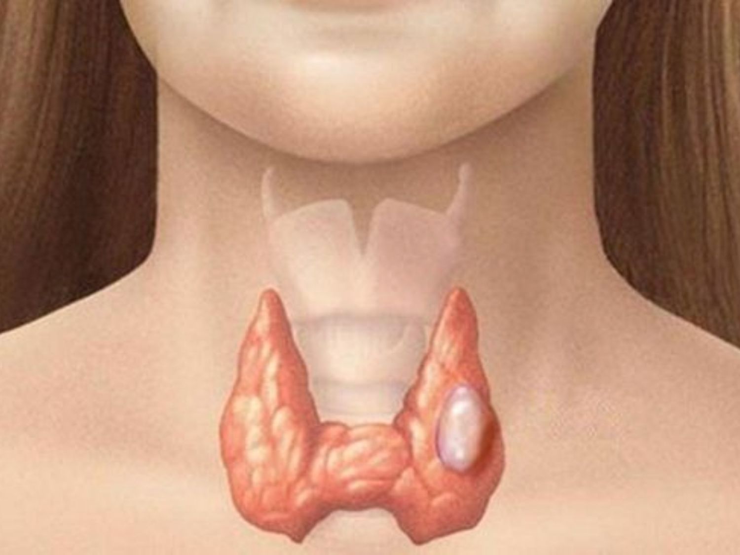 Cắt thùy tuyến giáp 1 bên