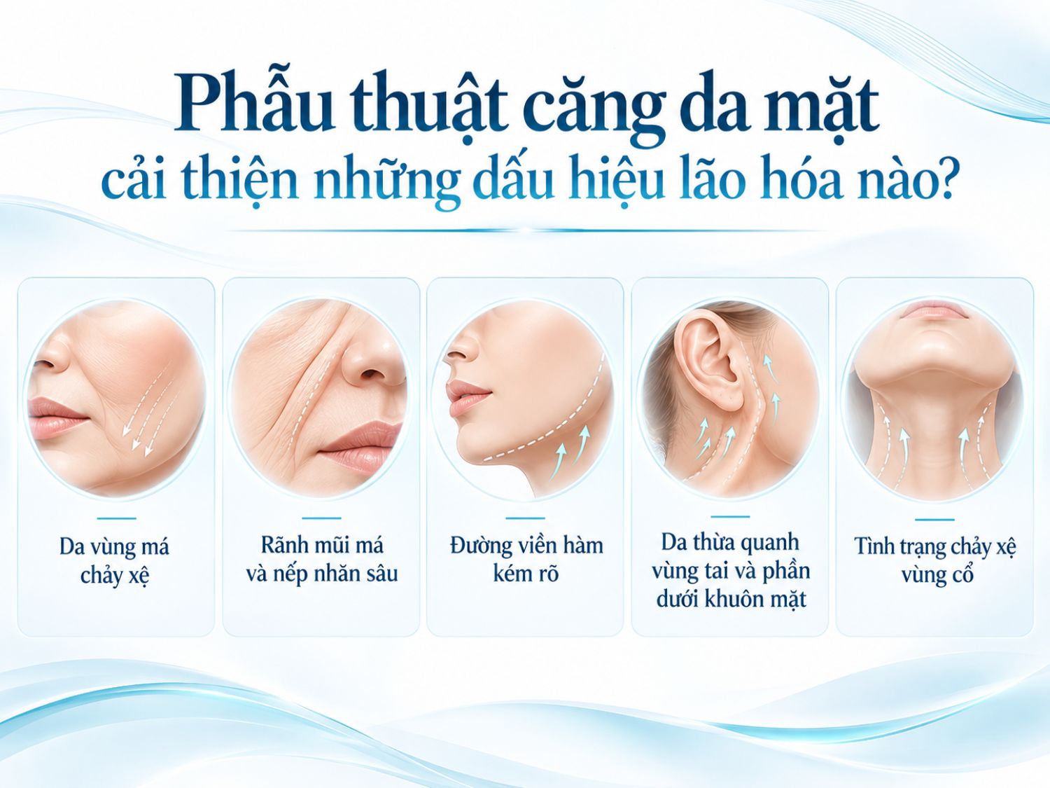 Phẫu thuật căng da mặt có thể cải thiện tình trạng da má chảy xệ, nếp nhăn sâu, đường viền hàm kém rõ, da thừa vùng mặt dưới và chảy xệ vùng cổ.